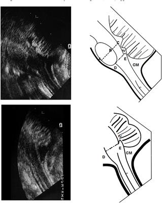 Sonographic Measurement of Brainstem Through the Foramen Magnum in Premature Neonates Can Predict Neurodevelopment Outcome?